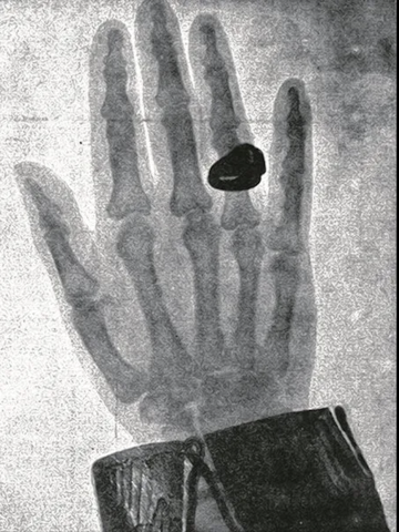 geröntgte Hand von Kaiser Franz Joseph